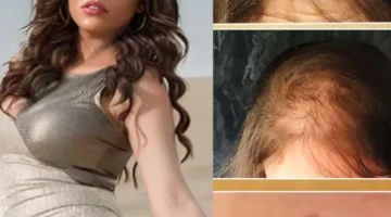 رحمة محسن تروي معاناتها الصحية المتفاقمة وتحول أزمة شعرها إلى عاهة دائمة